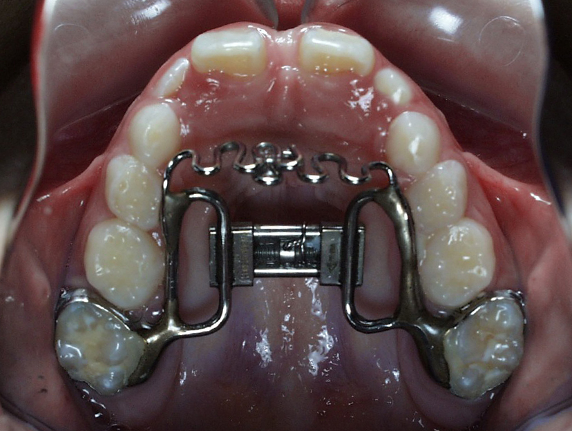 habit crib appliance orthodontic months bite following placement spontaneous closure activation initial showing three